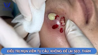 ĐIỀU TRỊ MỤN ÁP XE VÙNG CẰM KHÔNG ĐỂ LẠI SẸO VÀ THÂM TẠI PHÒNG KHÁM DA LIỄU HHV CLINIC