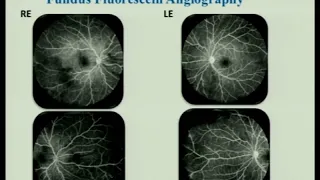 AIOC2018 - IC368 - Topic - Steroids interplay with antivirals in viral uveitis-friend or a foe? ....