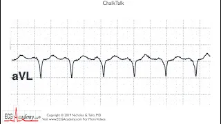 ECG Academy ChalkTalk 406