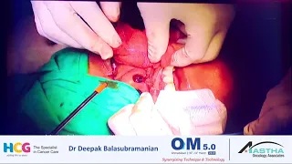 Total Maxillectomy Dr Deepak Balasubramanian