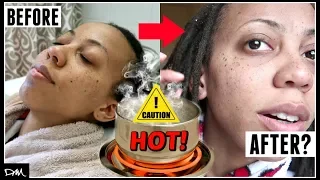 BOILING HOT! | Washing Dreadlocks In Hot Water? (Baking Soda + ACV Rinse)