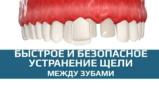 Виниры. Скрытие щели между зубами винирами