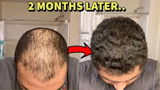 BALD GUY REVERSES HAIR LOSS IN 2 MONTHS! HERE'S WHAT HE DID!