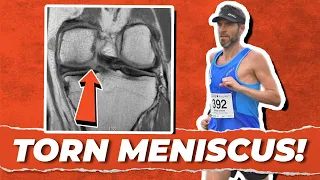 How I Returned to Running Post Meniscus Tear