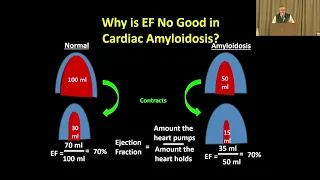 ATTR Cardiac Amyloidosis: Treating the Symptoms