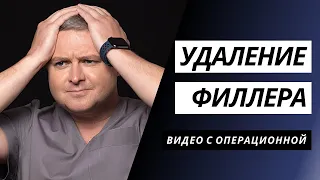 УДАЛЕНИЕ ФИЛЛЕРА | ⚠️ОБЯЗАТЕЛЬНО К ПРОСМОТРУ ПЕРЕД ВВЕДЕНИЕМ ГИАЛУРОНОВОЙ КИСЛОТЫ В ЛИЦО | ОПЕРАЦИЯ