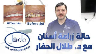 حالة زراعة أسنان مع د  طلال الحفار، مجمع جويل الطبي في جدة