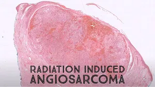 Radiation-associated Angiosarcoma & post radiation therapy reactive changes (pathology dermpath)