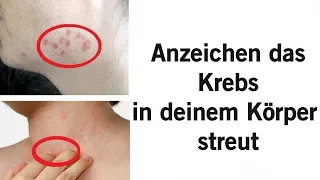 10 Frühe Symptome von Krebs, die die meisten Menschen nicht kennen