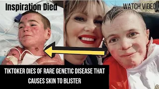 marky jaquez passed away | TikToker Dies of Rare Genetic Disease That Causes Skin to Blister