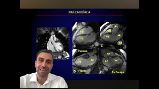 Angiotomografia de artérias coronárias e ressonância magnética cardíaca