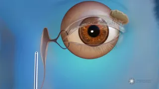 What is endoscopic dacryocystorhinostomy (DCR) surgery for blocked tear ducts?