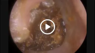 954 - Colossal Aural Polyp Ear Wax Removal