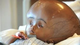 New Hope For Swollen Head Baby