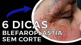 Como fazer a Blefaroplastia sem Corte - 6 DICAS!!