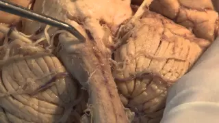 The Visual Pathway: Neuroanatomy Video Lab - Brain Dissections