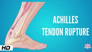 Achilles tendon rupture, Causes, Signs and Symptoms, Diagnosis and Treatment