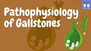 Gallstones [Pathophysiology, Cholecystitis, Choledocholithiasis, Diagnosis, Complications,Treatment]
