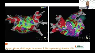 Advancements in Atrial Fibrillation