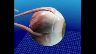Molteno3 Glaucoma implant insertion: animation