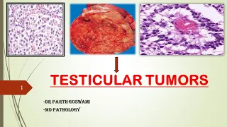 Testicular Tumors | Germ cell & Sex cord Stromal Tumors | Seminoma