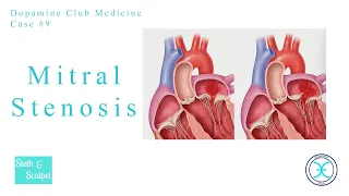 Mitral Stenosis | Medicine Quick Revision | Cardio Vascular System (CVS) Diseases | Dopamine Club