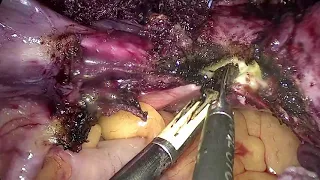 Total Laparoscopic Hysterectomy with 3 previous LS c-sections (SKAFF)