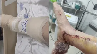 Relato de uma recuperação depois do acidente de moto.