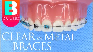 Clear Braces vs Metal Braces