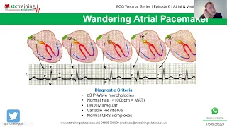 ECG Webinar Series | Episode 6 | Atrial & Ventricular Anomalies