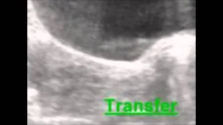 Der Embryotransfer