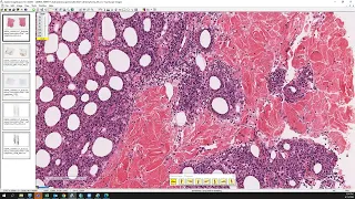 Subcutaneous panniculitis-like T-cell lymphoma