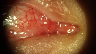 Head Hair Removed from Eye Tear Duct