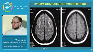 «МРТ в диагностике острых нарушений мозгового кровообращения по ишемическому типу»