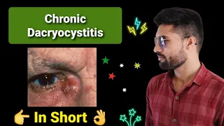 Chronic Dacryocystitis lecture opthalmology in short