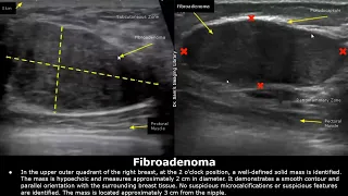 Breast Ultrasound Reporting | BIRADS Pathologies | How To Write USG Scan Reports | Breast Diseases