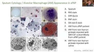 Dr. Bruce Trapnell - Autoimmune PAP pathogenesis, epidemiology, diagnosis, history, treatment + Q&A