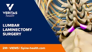 Lumbar Laminectomy Surgery