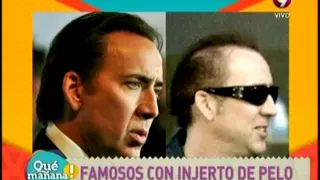 Famosos con injerto de pelo