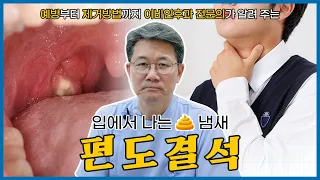 [하나이비인후과병원] 입 안의 똥! 입 냄새의 주범! 편도결석 예방부터 치료방법, 제거까지 편도결석의 모든 것!