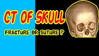 CT Imaging of Skull: Is that a Fracture or Suture ?