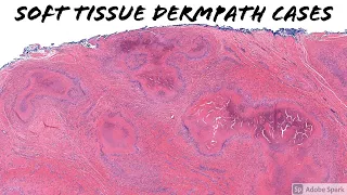 Soft Tissue Tumor Dermpath Unknown Cases Emory Dermatology -digital slide links in video description