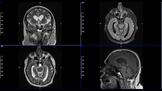 Brain MRI of Parkinsonian signs and symptoms & possible Normal Pressure Hydrocephalus (NPH).