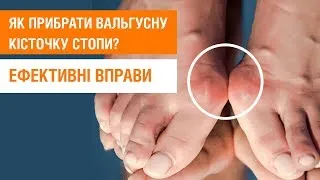 Вальгусна кісточка. Ефективні вправи для усунення деформації вальгусної кісточки | SkyFitness