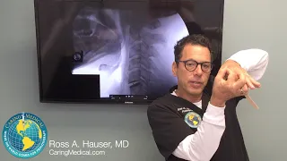 Neck pain after C5-C6 disc replacement surgery - DMX review with Ross Hauser, MD