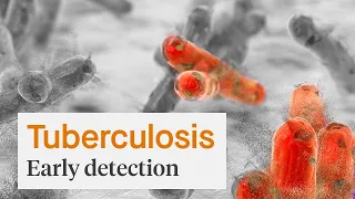 Early Detection of Tuberculosis