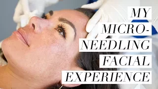 My Microneedling Facial Experience