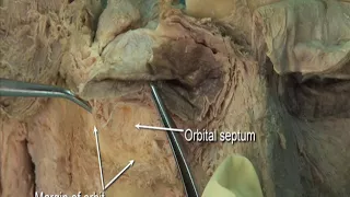 1.10 Step 1. Orbital septum and periorbita; lacrimal apparatus