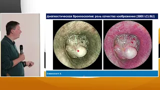 4. Сивокозов ИВ Бронхоскопия высокой четкости - современные возможности.