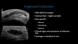 US for Extremity and Soft Tissue Infections